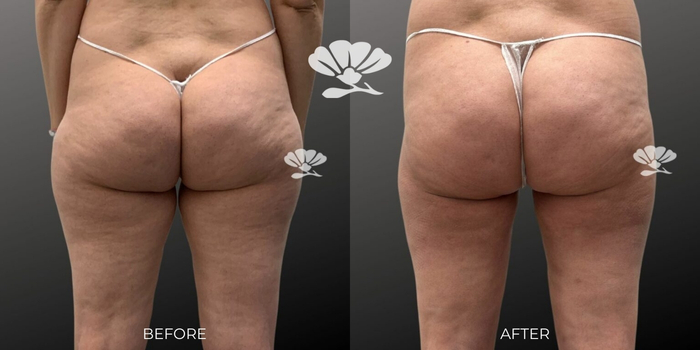 Surgical skin tightening thighs Perth Renuvion