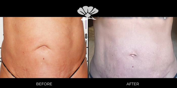 Renuvion and Liposuction to abdomen