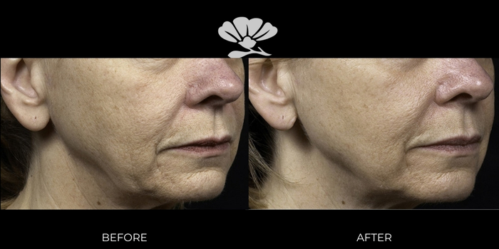 RF facial skin tightening jowls Perth