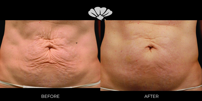 Best RadioFrequency skin tightening Perth stomach abdomen