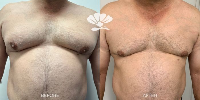 Gynecomastia Male Breast Reduction Surgery Perth