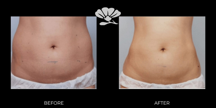 Ultraformer Perth Before and After Treatment