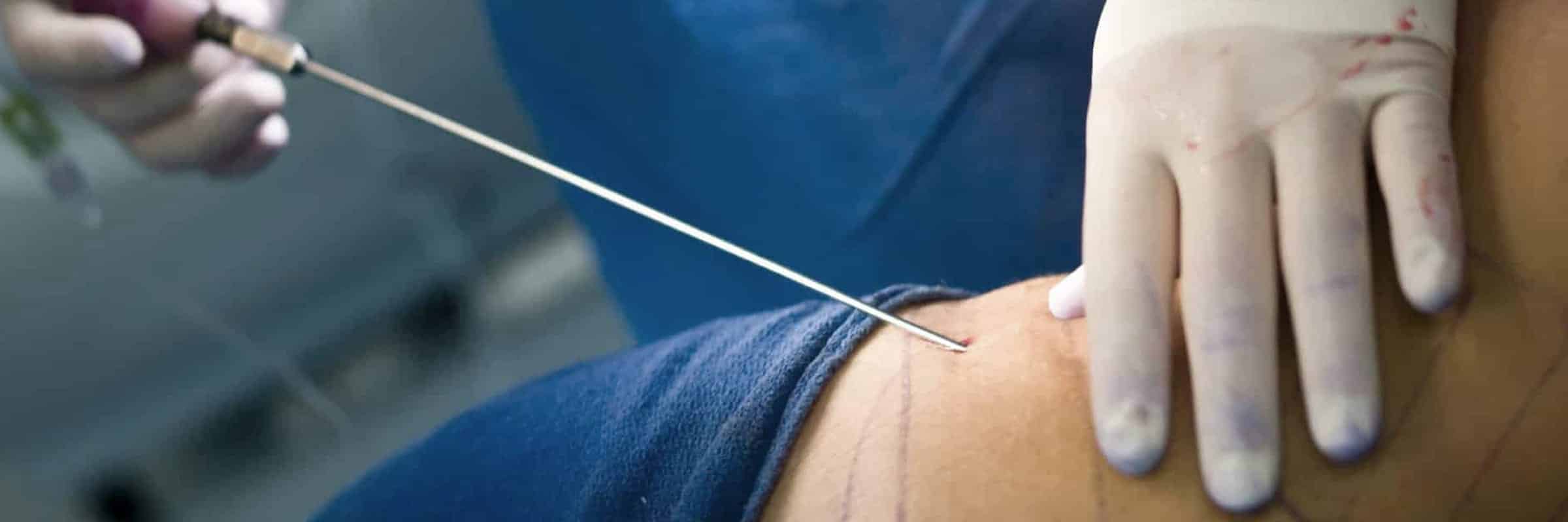Liposculpture weight loss bariatric surgery injections perth