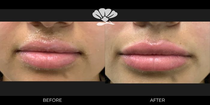 Lip Filler 0.5ml Before After