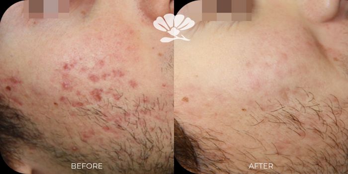 Best Acne treatment near me Perth Joondalup