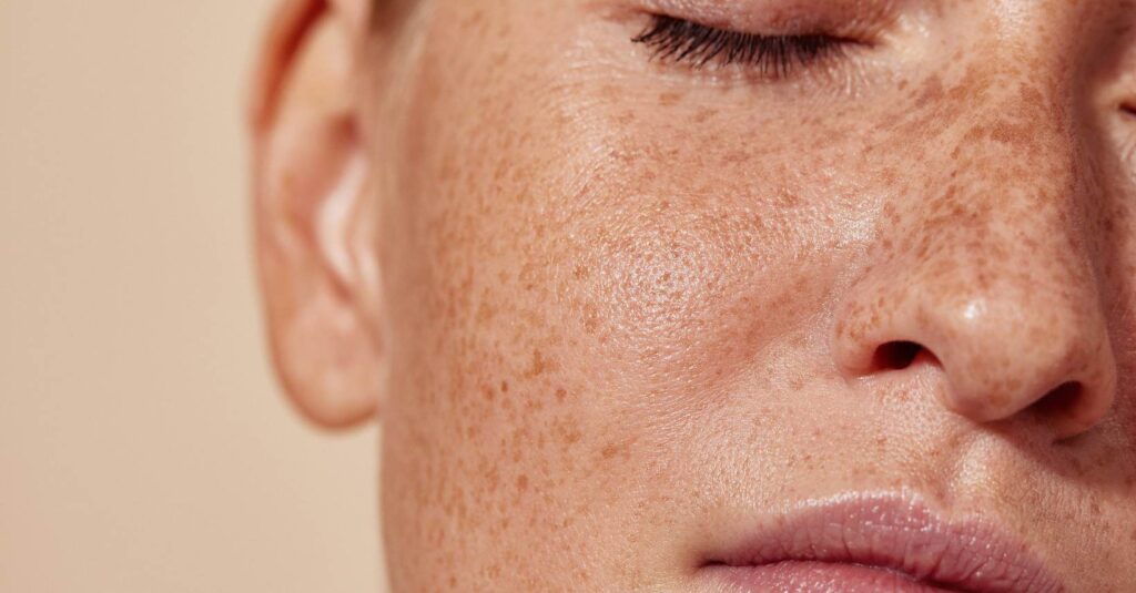 Pigmentation treatment Perth Joondalup sun spots melasma