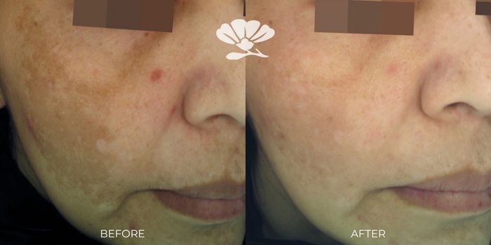 Cosmelan best pigmentation treatment melasma Perth applecross