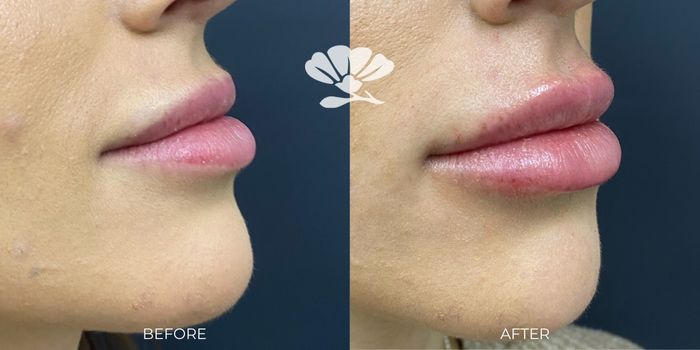 Lip Filler Before After 0.5ml