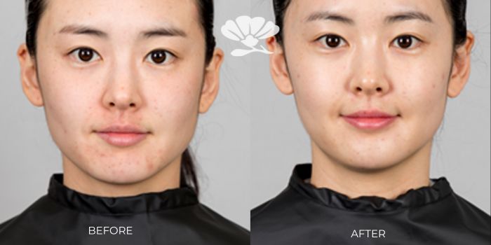 Cosmetic Injectable