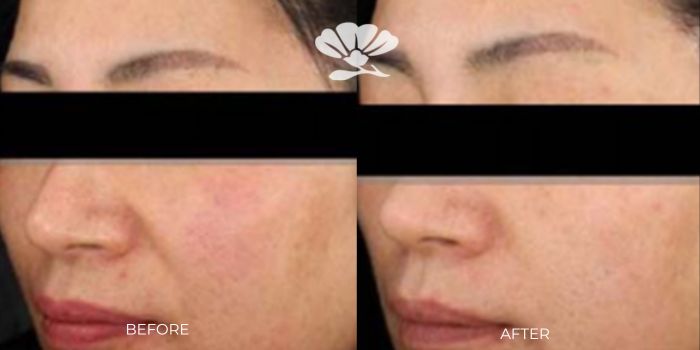 Cosmetic Injectable